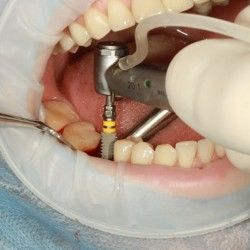 Premium Dental Implants in Sydney – Expert Care & Proven Results Premium Dental Implants in Sydney – Expert Care & Proven Results