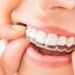 Invisible Braces Cost Sydney – From $1650 For Both Arches