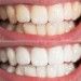 Invisible Braces Cost Sydney – From $1650 For Both Arches