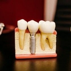 Dental Implants Cost in Sydney – Quality Treatment, Lasting Results Dental Implants Cost in Sydney – Quality Treatment, Lasting Results