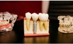 Dental Implants Cost in Sydney – Quality Treatment, Lasting Results