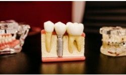 Refining Smiles with a Tailored Dental Implants Cost in Sydney